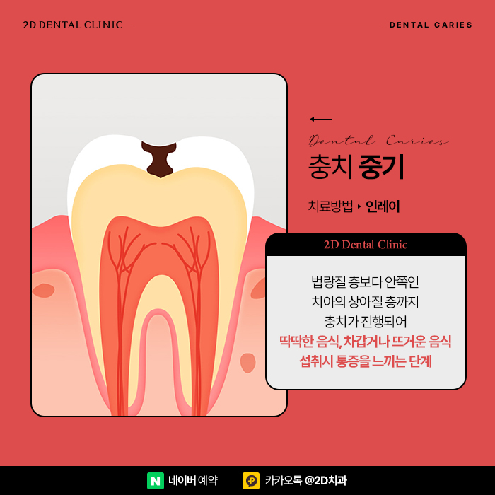 어금니충치치료 빠르게 진행해야 이유, 단계별 레진, 인레이, 크라운 순서 관련 이미지 6
