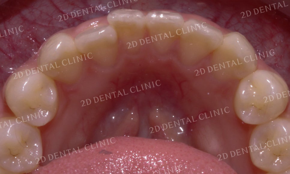 [앞니교정]토끼앞니교정, 부분교정으로 토끼이빨 탈출하기! by.투디치과(2D치과) 관련 이미지 6