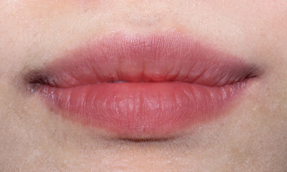 토끼 이빨 치아교정 5개월 교정 완료! by. 투디치과(2D치과) 관련 이미지 6