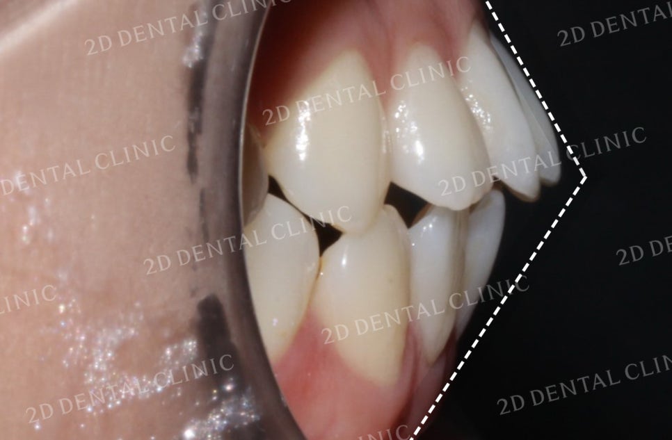 비대칭 앞니, 돌출앞니를 전체 교정으로 교정하고 싶다면!? by.투디치과(2D치과) 관련 이미지 8