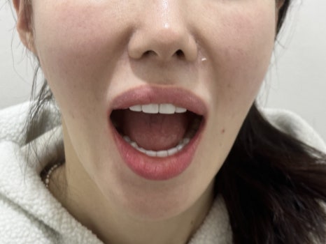 무삭제라미네이트 블랙필름 케이스 비포 에프터 후기 관련 이미지 5