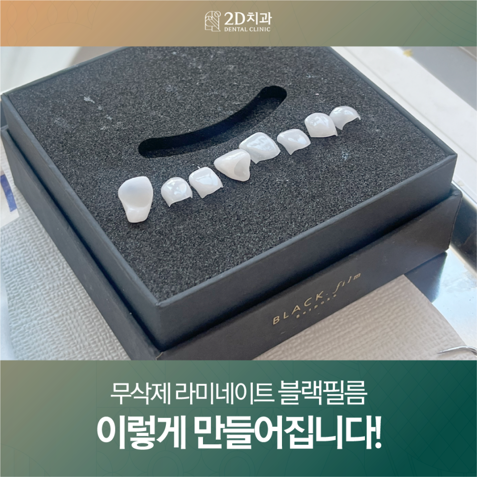 강남라미네이트 앞니교정 블랙필름 이렇게 만들어집니다! 관련 이미지 1