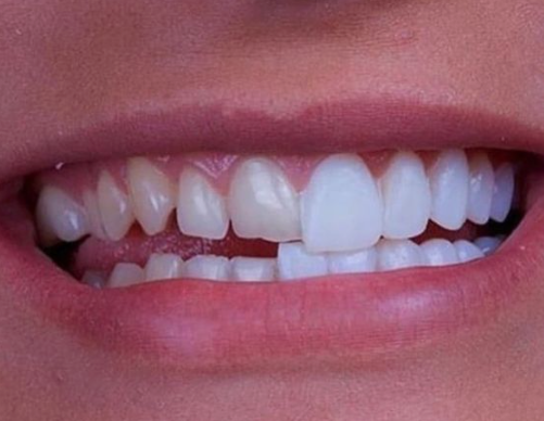 치아삭제 없는 블랙필름 무삭제라미네이트가격 관련 이미지 6