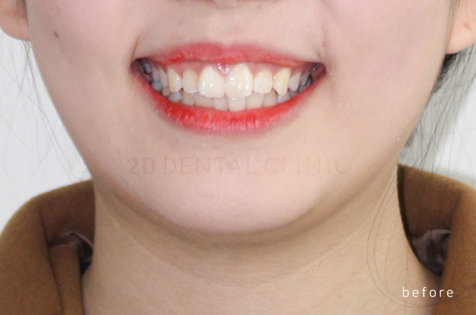 [돌출입 무턱] 안모교정 진행중! by.투디치과(투디치과)전체교정 관련 이미지 3