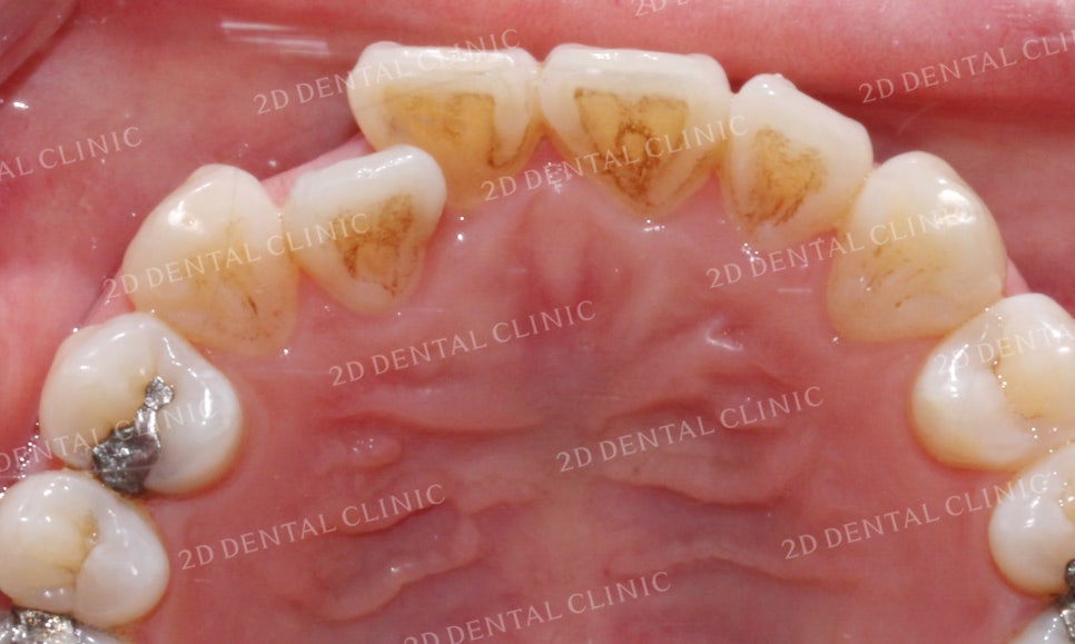 [앞니교정]부정교합교정, 부분교정으로 완성하기! by.투디치과(2D치과) 관련 이미지 6