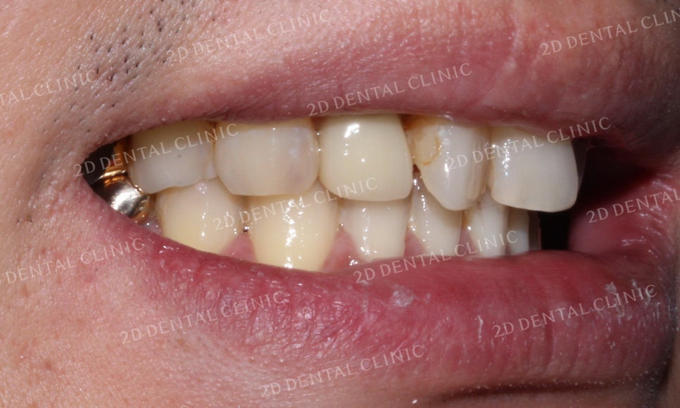 [2D교정] 나비치아교정을 2D교정 장치로 빠르게 완성하기! by.2D치과(투디치과) 관련 이미지 11