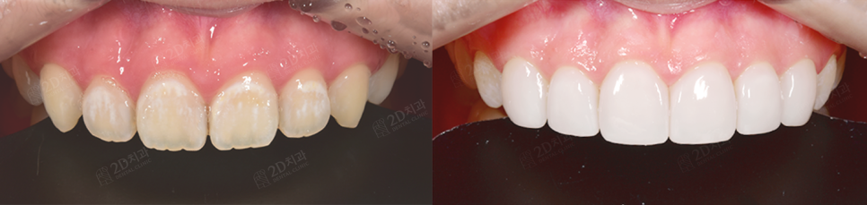 무삭제라미네이트 <블랙필름> 신논현역 투디치과 관련 이미지 1