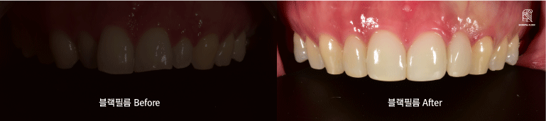 무삭제라미네이트는 어느 병원에서 해야할까요? 관련 이미지 6
