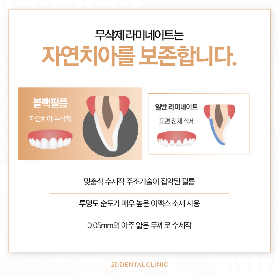 무삭제라미네이트가격 치아미백치과 앞니 고민 있다면 관련 이미지 5