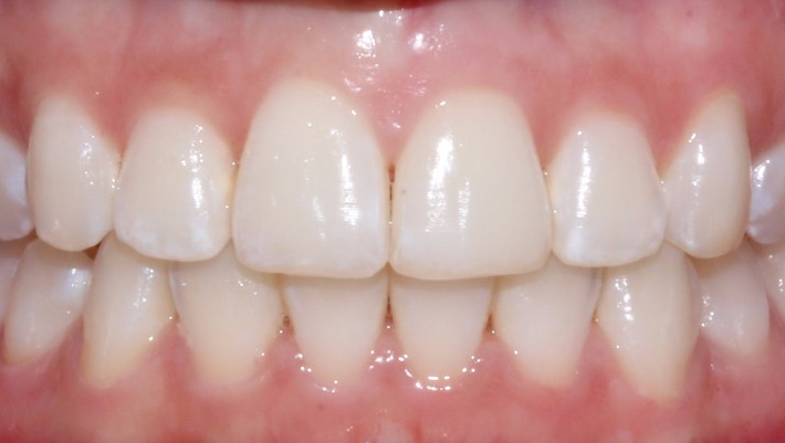 [신논현역치과] 앞니돌출 2D교정으로 개선! 관련 이미지 3