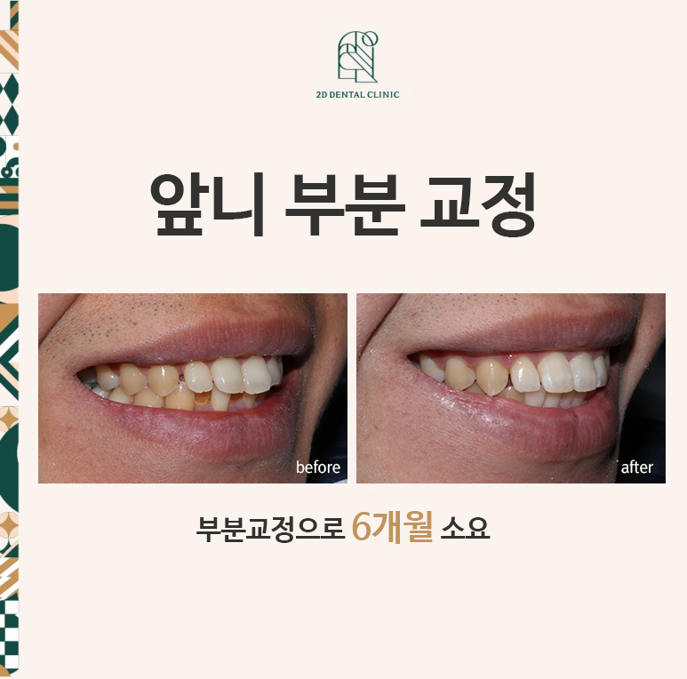 뻐드렁니 교정, 강남역치과에서 앞니 부분 교정한 후기! 관련 이미지 1