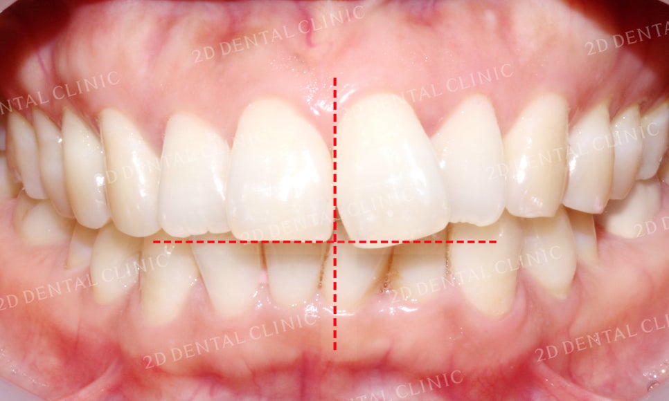 [앞니교정] 돌출앞니교정, 토끼앞니를 클리피씨교정으로 완성하기! by. 투디치과(2D치과) 관련 이미지 5