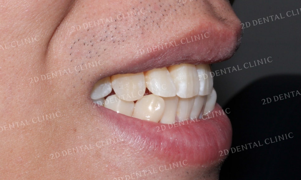 [앞니교정]부정교합교정, 부분교정으로 완성하기! by.투디치과(2D치과) 관련 이미지 12