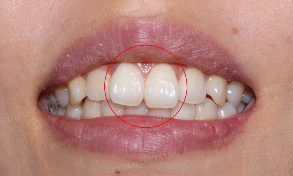 [2D교정] 나비치아, 앞니교정 설측교정으로 빠르게 하는 방법! by.2D치과(투디치과) 관련 이미지 3