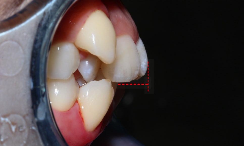 crowding 송곳니덧니 세라믹교정 방법 관련 이미지 4