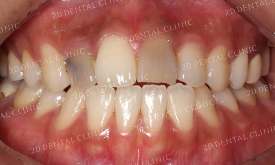 치아변색, 까맣게 변한 변색치를 블링스(Blinx)로 수복하기! by. 투디치과(2D치과) 관련 이미지 8