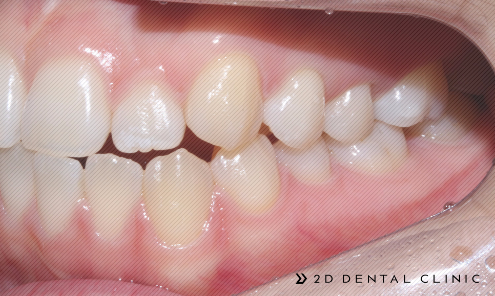 절단교합 교정 케이스 전후비교, 교정전문 2D치과 관련 이미지 14