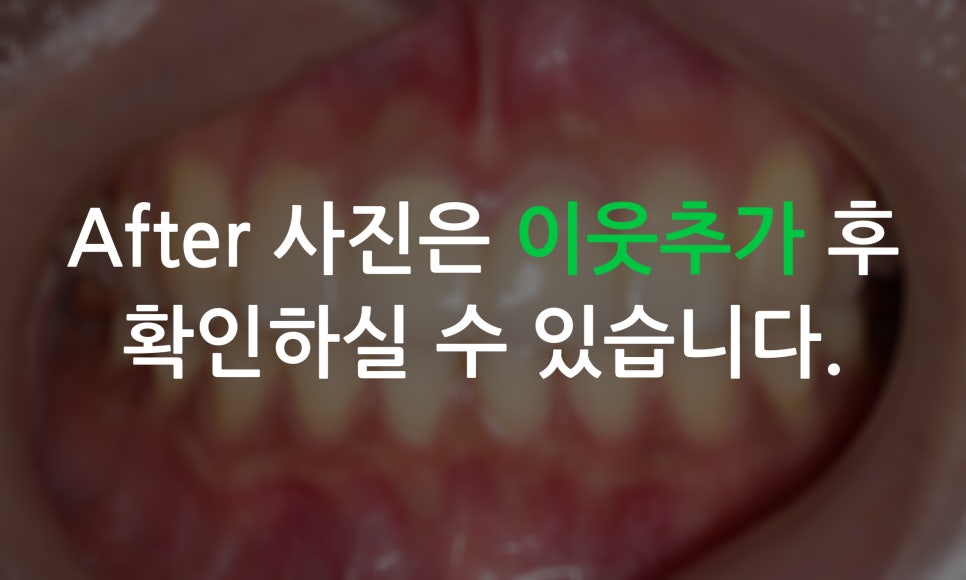 토끼앞니교정, PFM크라운 재보철을 동시에 치료하는 방법? 관련 이미지 8