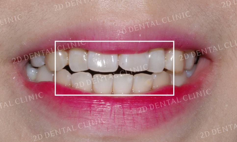 [앞니교정] 부정교합 교정, 앞니교정으로 부정교합 교정하는 방법! by. 투디치과(2D치과) 관련 이미지 3