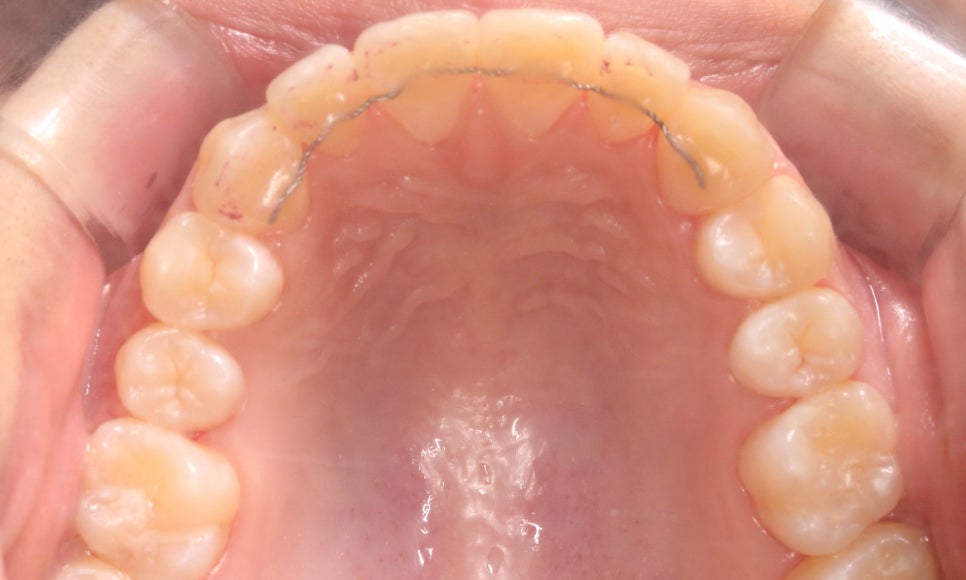 톱니모양 치아를 매끄러운 치아모양으로 개선하는 방법! (마멜론치아) 관련 이미지 9