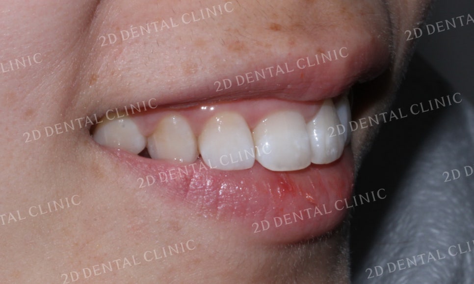 [투디교정] 덧니교정, 앞니교정으로 치열을 고르게! by.투디치과(2D치과) 관련 이미지 12