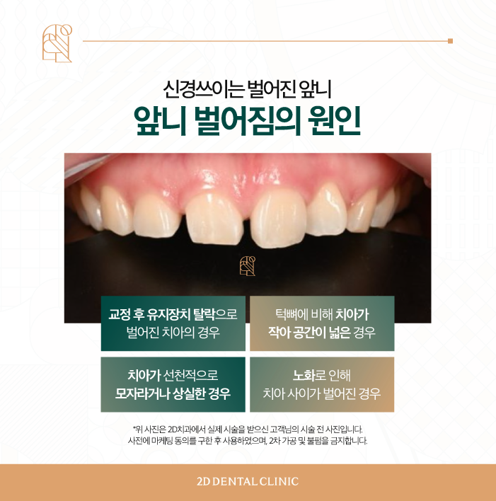 강남무삭제라미네이트 신논현역치과 블랙필름 벌어진 앞니도 걱정 없이! 관련 이미지 3