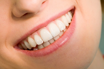 치아교정과 무삭제라미네이트 블랙필름 나에게 맞는 시술찾기 관련 이미지 2