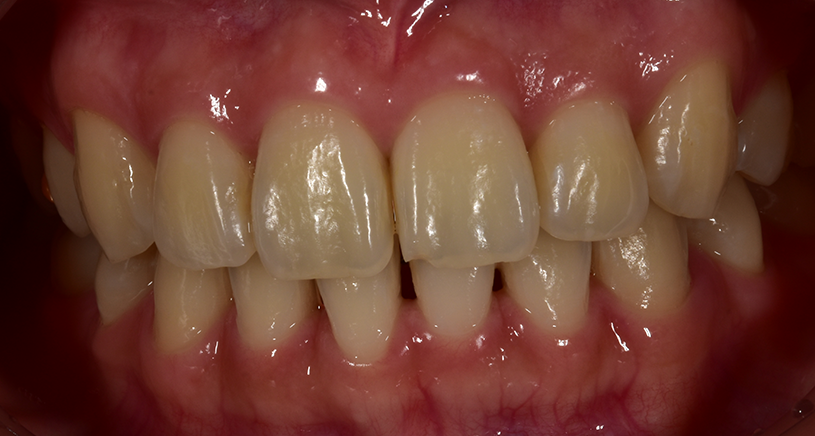 치아 블랙트라이앵글 원인, 예방, 치료 무삭제라미네이트 관련 이미지 9