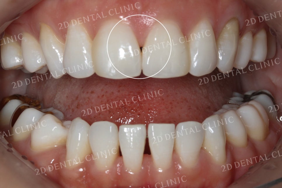 치아틈새를 완벽하게 메꾸자! 블랙트라이앵글 쎄라필름으로 완전 삭제! by.투디치과(2D치과) 관련 이미지 2