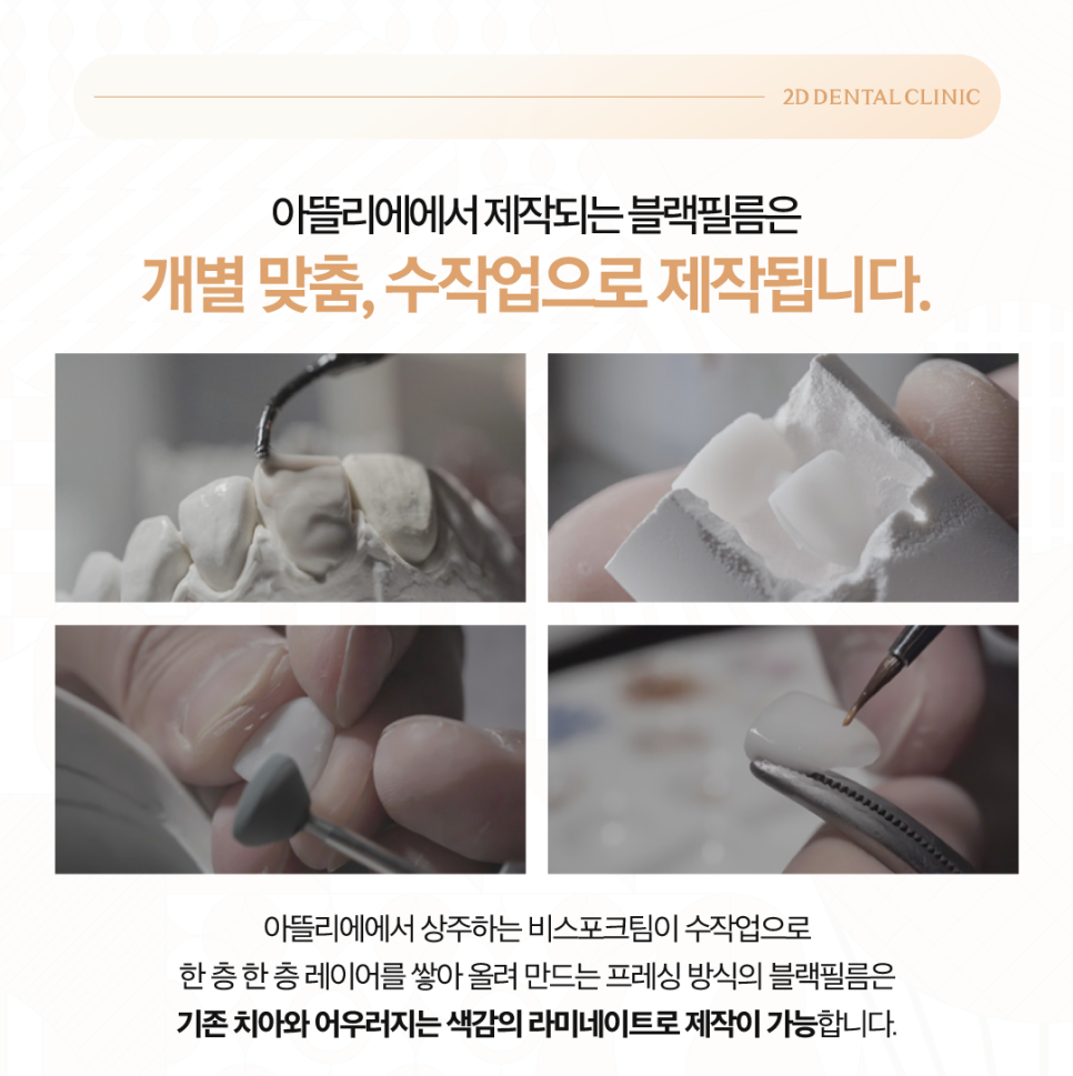 광주무삭제라미네이트 앞니성형 투디에서 디테일한 치아 개선을 관련 이미지 4