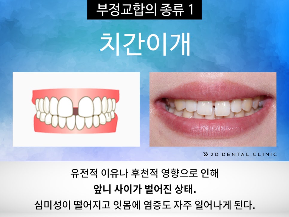 [교정상식] 부정교합 종류! 나는 어떤 케이스에 해당될까? 관련 이미지 4
