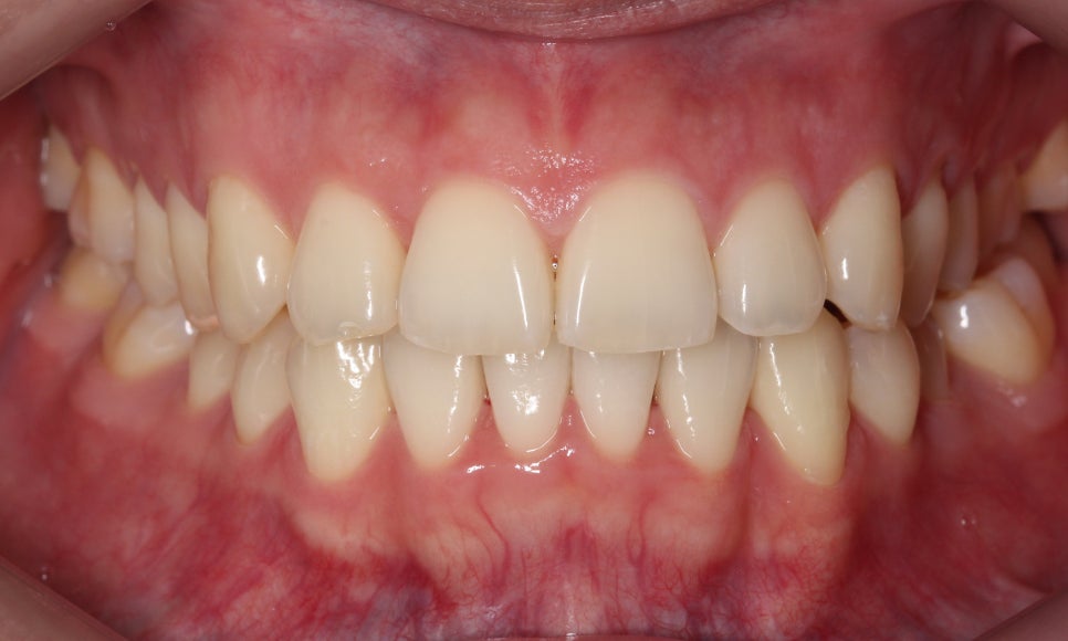 부분교정으로 삐뚤어진 앞니 예뻐지는 방법 관련 이미지 14