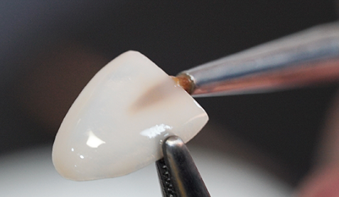 무삭제라미네이트후기 치아삭제없는 블랙필름 관련 이미지 4