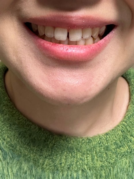 무삭제라미네이트 블랙필름 케이스 비포 에프터 후기 관련 이미지 8