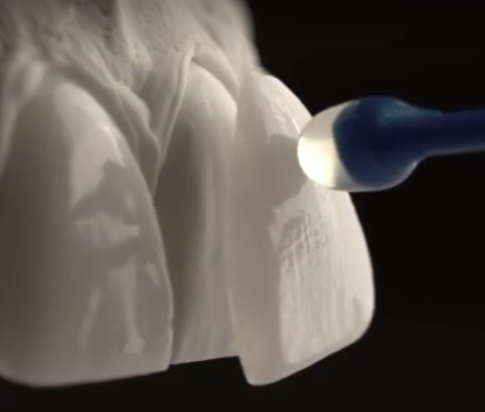 치아손상없는 깎거나 삭제없는 무삭제라미네이트가격 관련 이미지 3