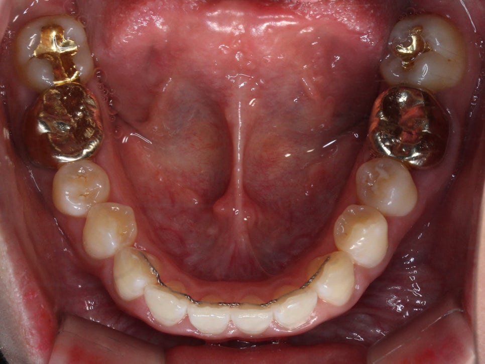 덧니 투명교정 8개월 치료 사례 관련 이미지 14