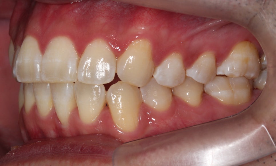 앞니 덧니 고민, 부분 설측 교정으로 해결한 사례 관련 이미지 15