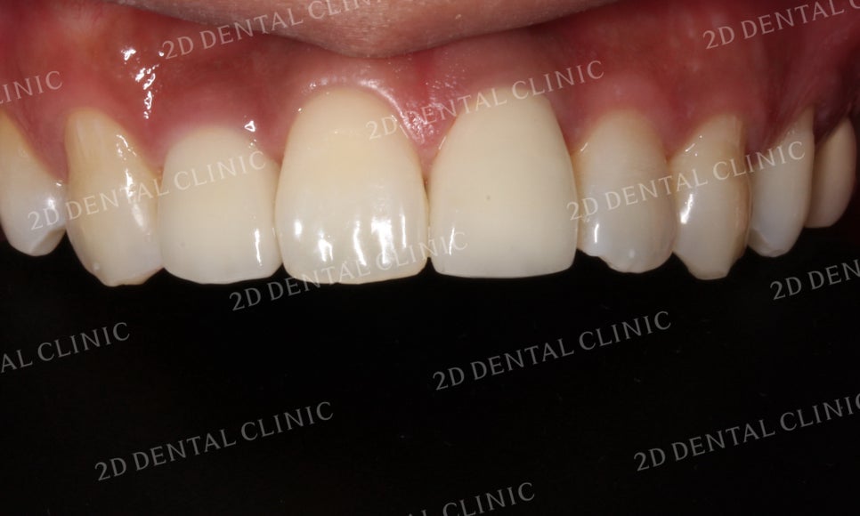 치아변색, 까맣게 변한 변색치를 블링스(Blinx)로 수복하기! by. 투디치과(2D치과) 관련 이미지 17