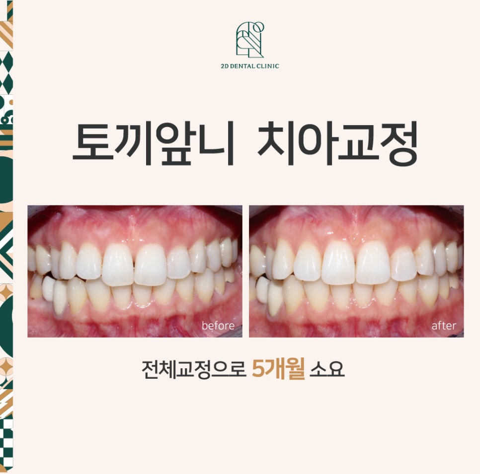토끼 이빨 치아교정 5개월 교정 완료! by. 투디치과(2D치과) 관련 이미지 1