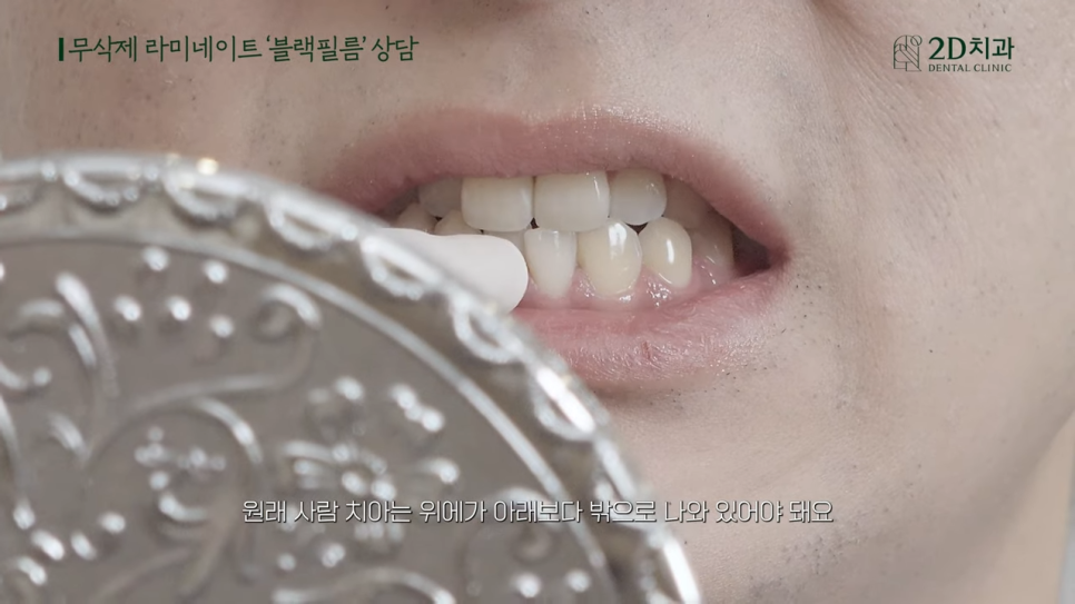 [블랙필름 상담받고 왔어요] #2 반대교합도 가능할까요? 관련 이미지 9