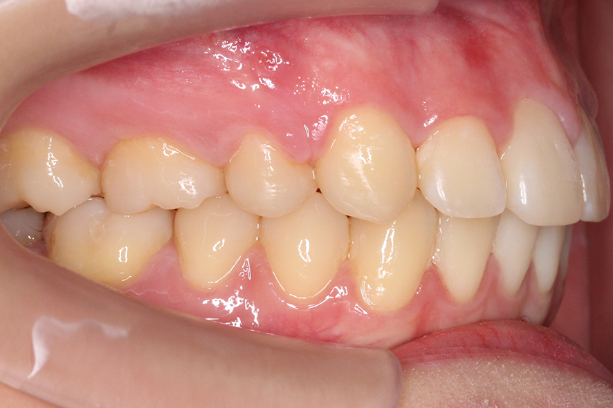 입돌출 데이몬교정 Case1 관련 이미지 12