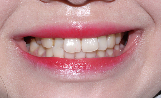 2D치과 2D교정으로 4개월만에 덧니 개선! 관련 이미지 2