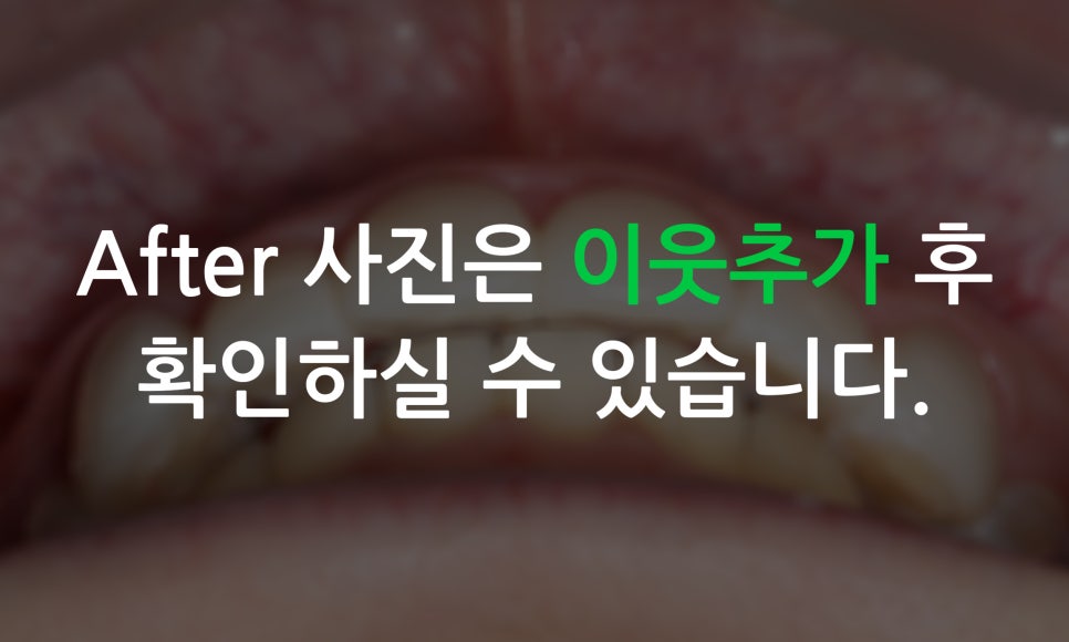 송곳니덧니 교정과 왜소치 세라필름을 한번에! 관련 이미지 9