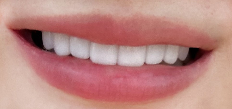 무삭제라미네이트후기 치아삭제없는 블랙필름 관련 이미지 12