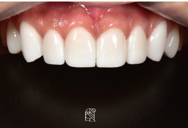 앞니충치 무삭제라미네이트비용 블랙필름 관련 이미지 8