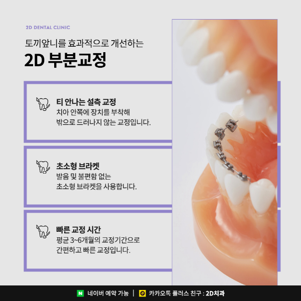 수지처럼 토끼앞니라면? 2D부분교정으로 개선 가능 관련 이미지 3