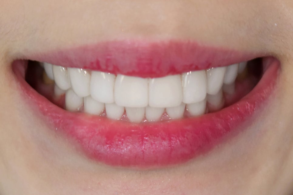 연예인라미네이트 무삭제로 잘하는 2D치과 관련 이미지 10