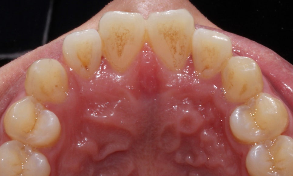 뻐드렁니 교정, 강남역치과에서 앞니 부분 교정한 후기! 관련 이미지 6