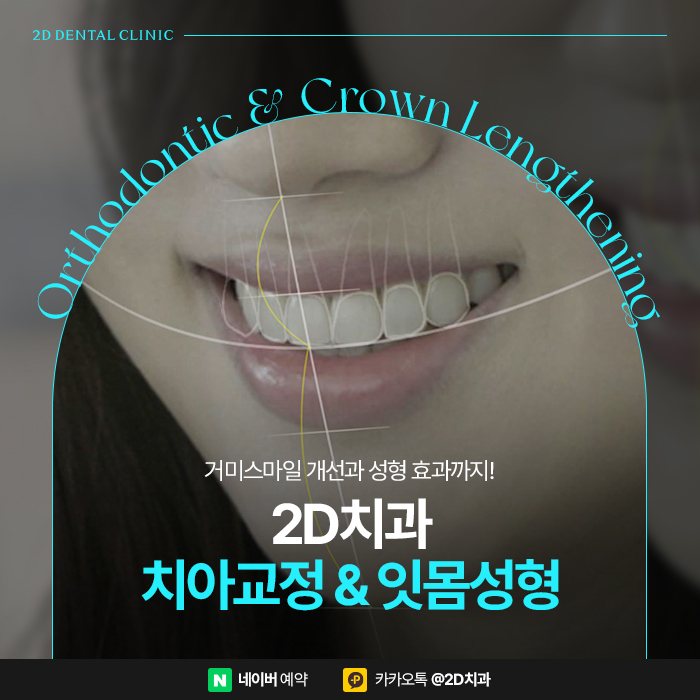 거미스마일 개선을 위한 치아교정, 강남 잇몸성형 관련 이미지 1