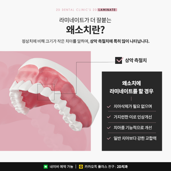 유난히 작은 치아 개선은? 2D 왜소치 라미네이트 교정 관련 이미지 2